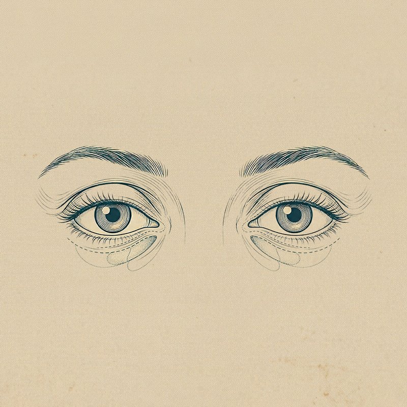 Alt Göz Kapağı Estetiği