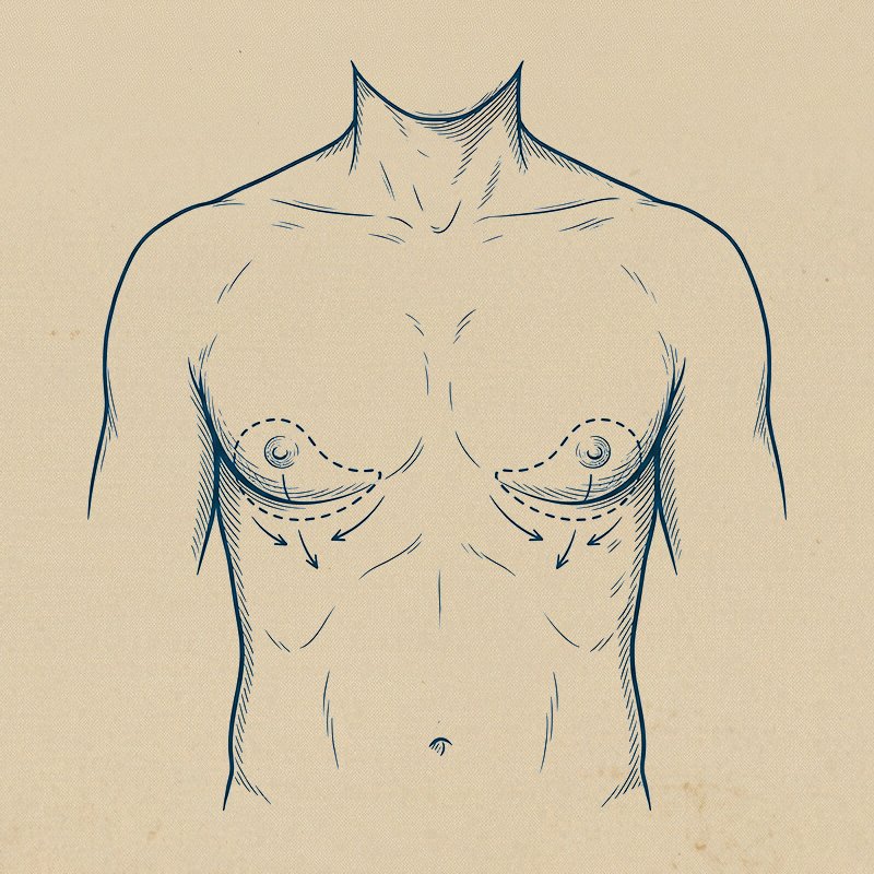 Jinekomasti (Erkeklerde Meme Ameliyatı)