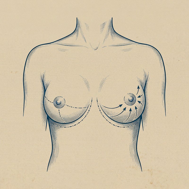 Meme Dikleştirme (Mastopeksi)