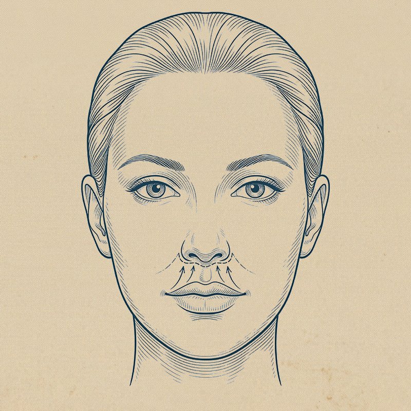 Üst Dudak Kaldırma (Lip Lift)