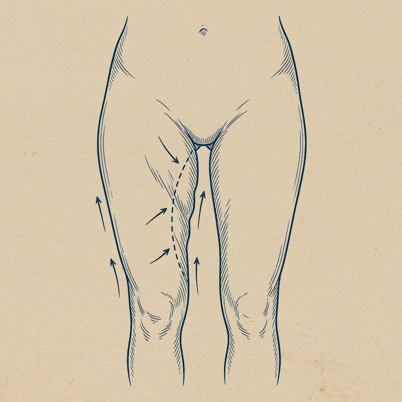 Uyluk Germe (Thigh Lift)